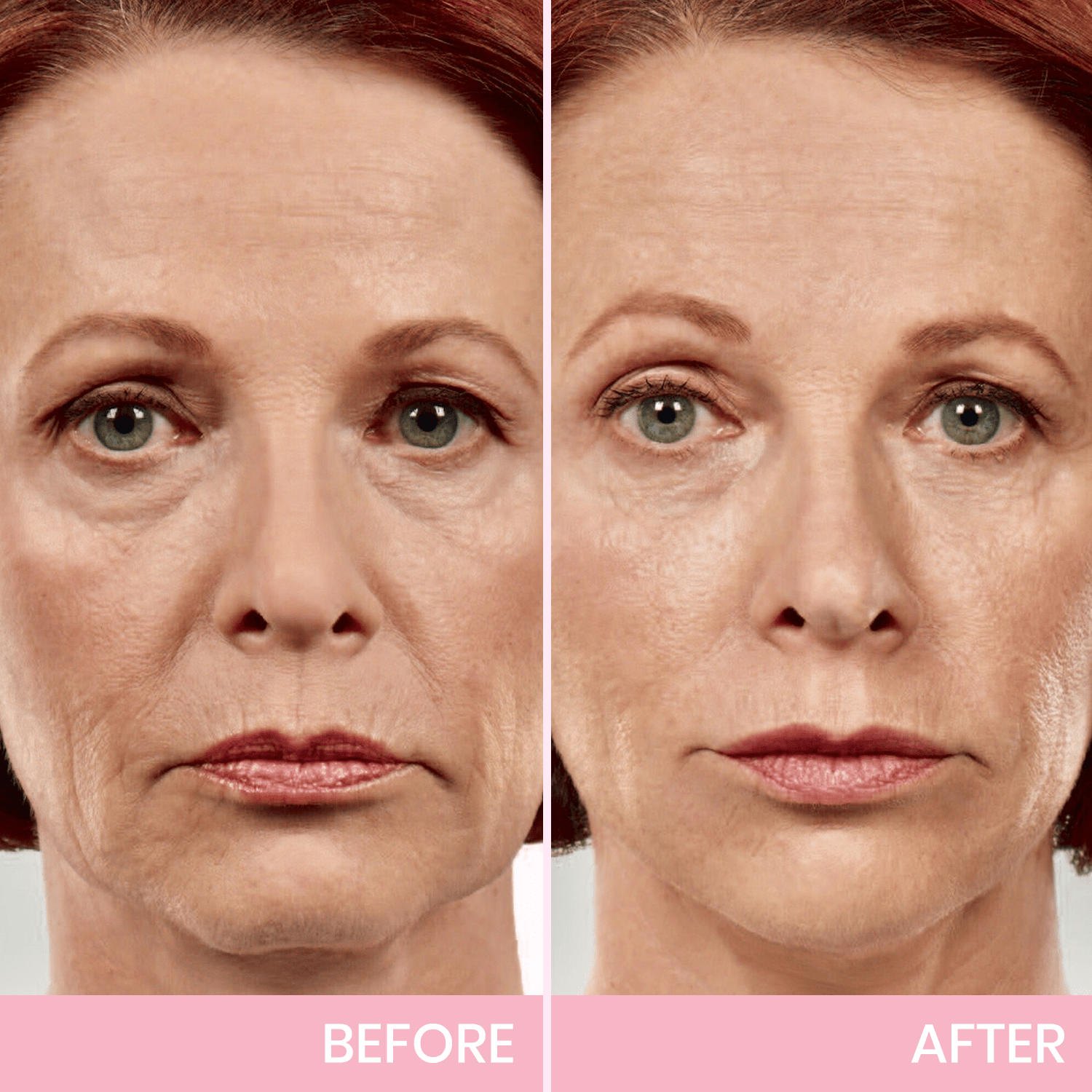 🎄CHRISTMAS SALE - 70% OFF in the Last 3 Hours!🎁 Give the Gift of Beauty This Christmas with BBOJI™ V-Face Tape for a Stunning Look.💄 Hurry! 🐰